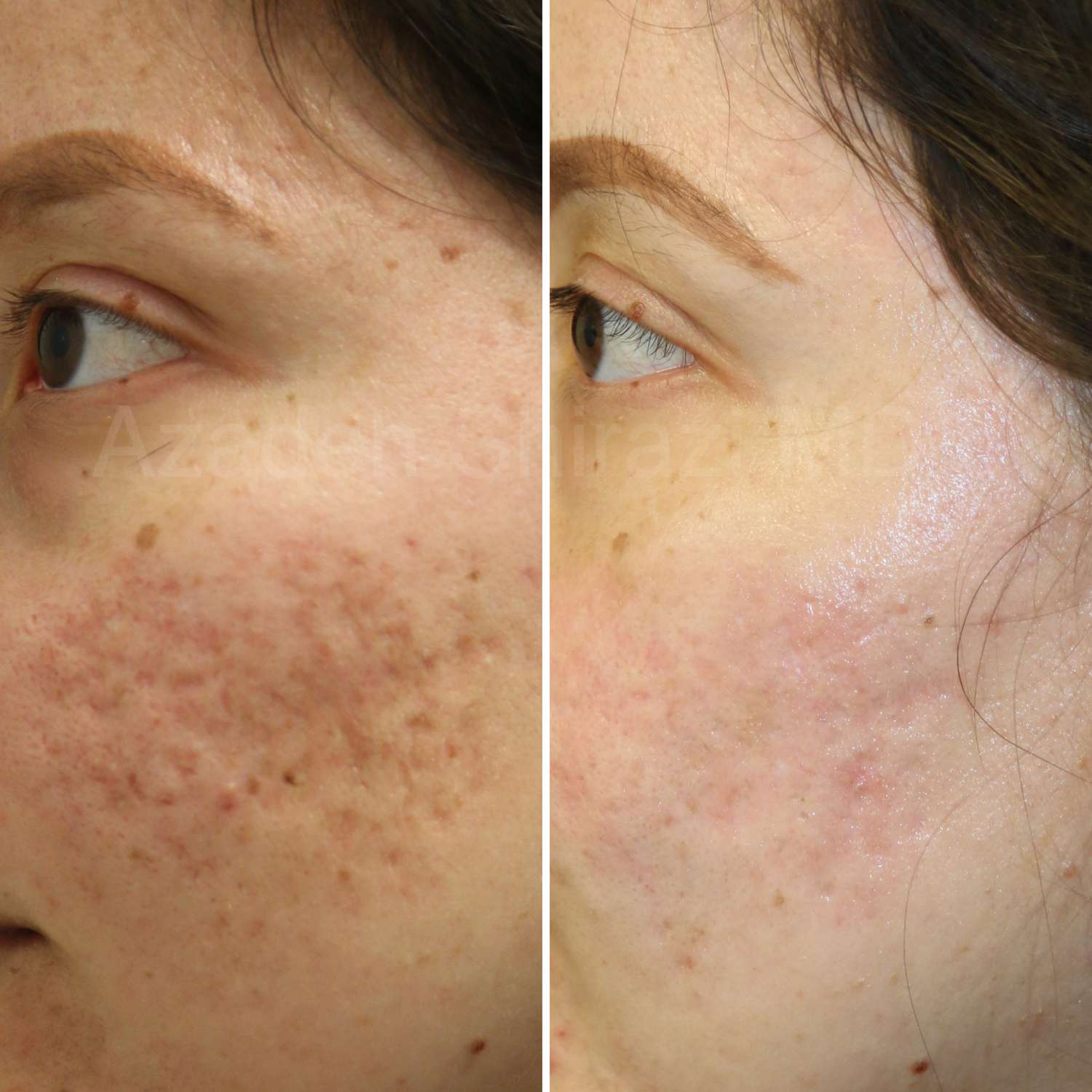Antes e depois da subcia com acne
