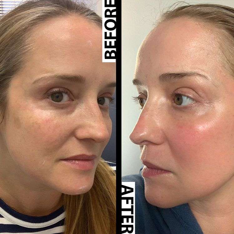 O rosto da escritora Leah Whyar antes e depois do tratamento com laser Fraxel