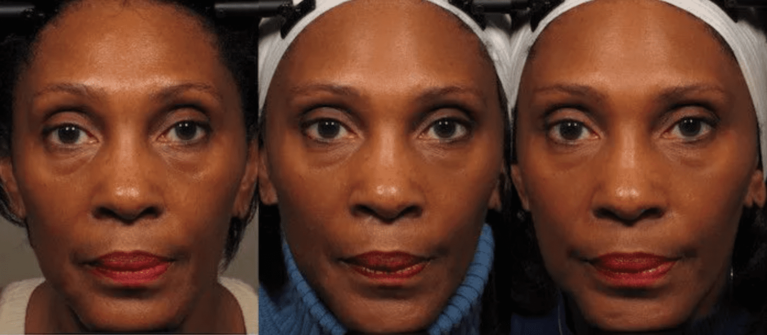 Rosto de mulher antes, depois de oito semanas e depois de 20 semanas de exercícios faciais