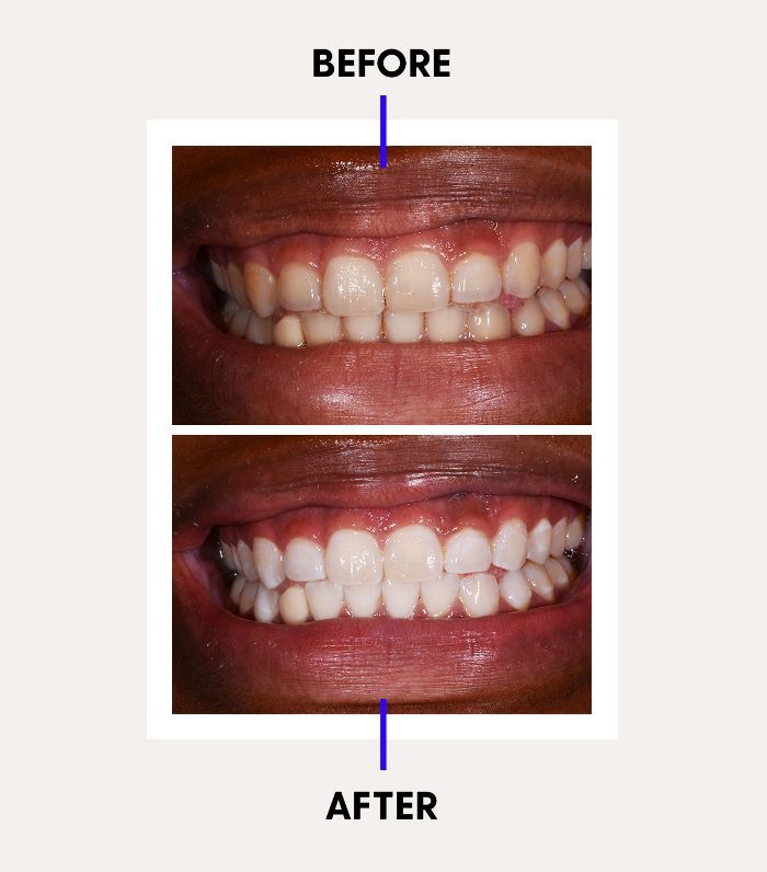Antes e depois do clareamento dental profissional