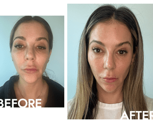 Fotos antes e depois de aplicar soro com vitamina C do autor de Corave Byrdie Eliza Tabin
