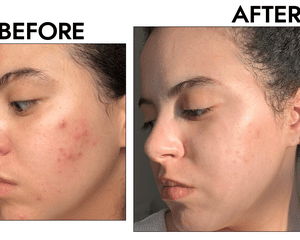 Mulher com acne antes e depois da foto