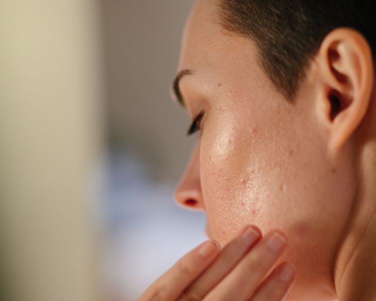 Uma mulher com cicatrizes da acne toca seu rosto